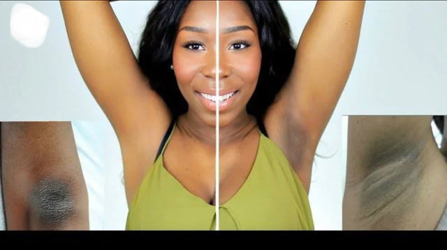 Jabón Kojie San para tratar eficazmente la hiperpigmentación, las manchas oscuras, las cicatrices del acné y el melasma.